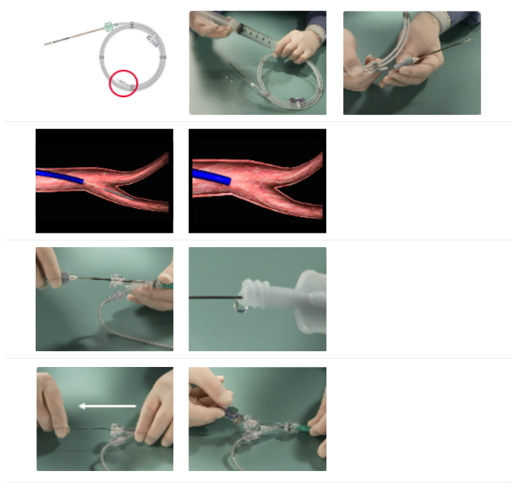 abbott-amplatzer-vascular-plug-deployment